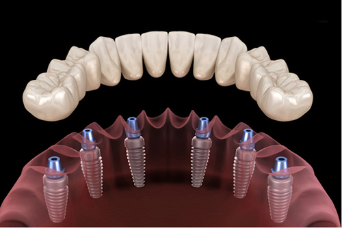 All On Six and All On Eight Implant Procedure and Prices in Turkey