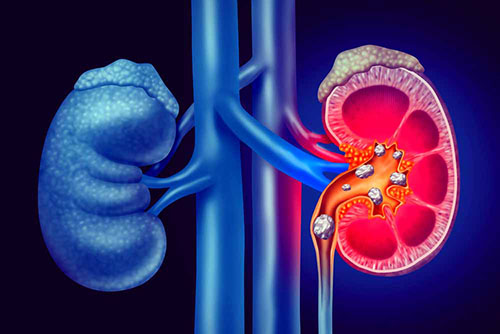 Calculs rénaux et urétéraux (canaux)