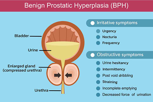 Hyperplasie bénigne de la prostate (HBP)