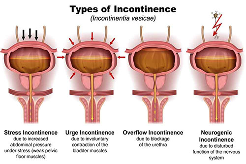 Incontinence Urinaire