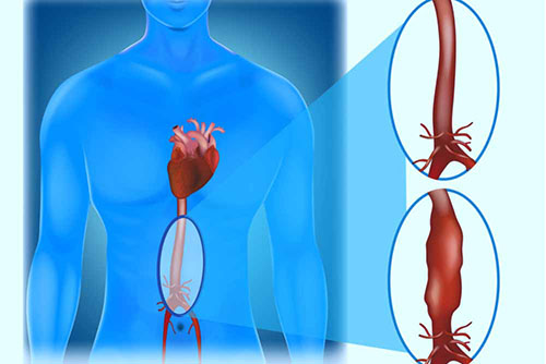 Chirurgie de l'anévrisme aortique