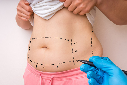 Abdominoplasty (Abdominal Lifting)