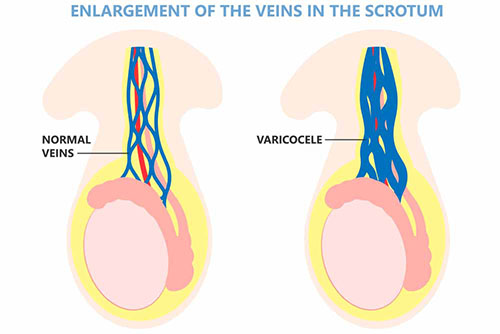 Varicocèle