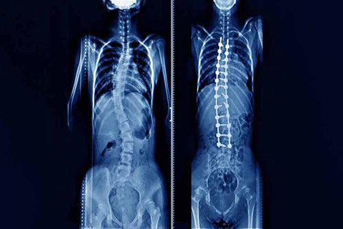 Spine Surgery