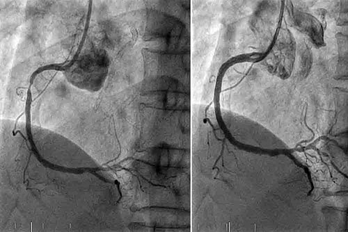 Angiographie coronaire