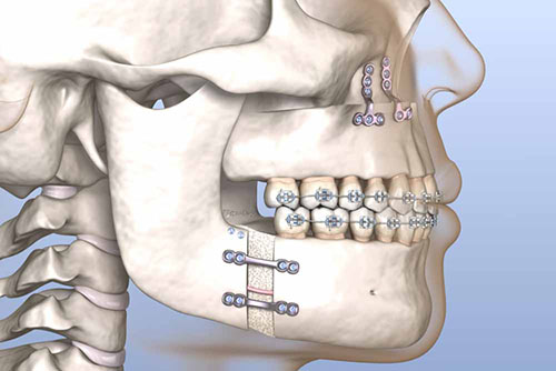 Jaw and Cheekbone Surgery