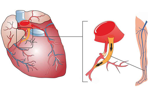 Chirurgie De Pontage Aortocoronarien