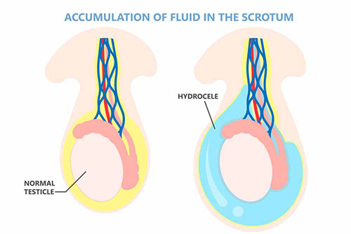 Hydrocèle