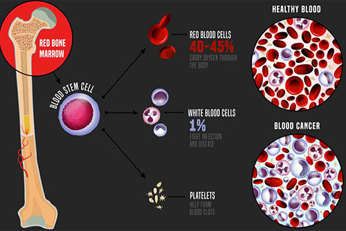 Leukemia