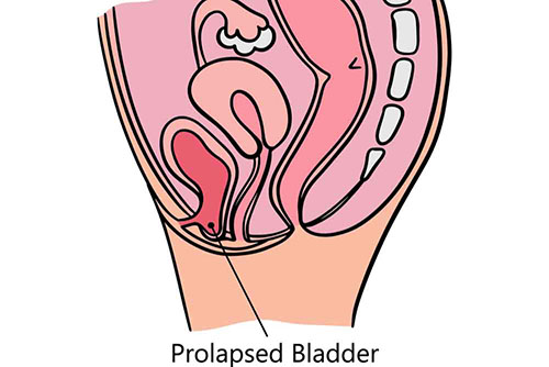 Prolapsus de la vessie