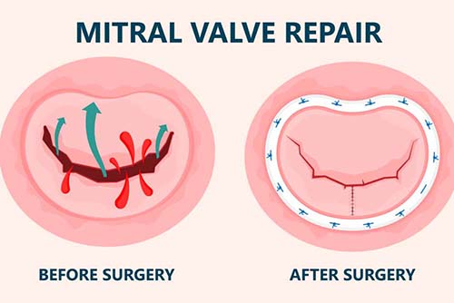 Chirurgie D'insuffisance De La Valve Mitrale