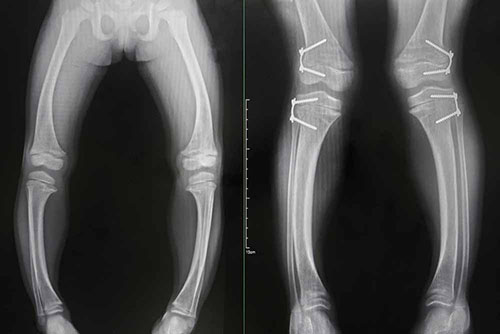 Chirurgie De La Deformation