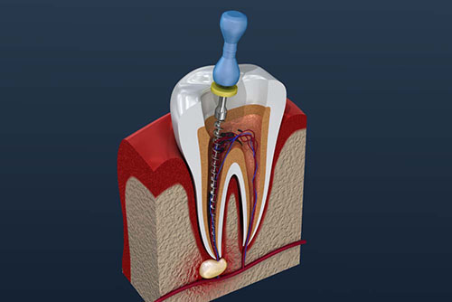 Endodontics