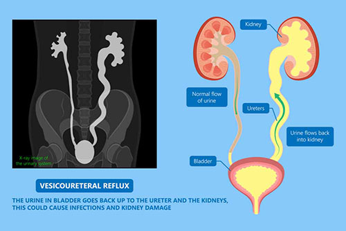 Reflux vésico-urétral