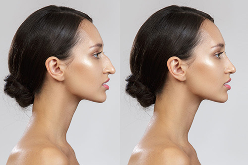 Rhinoplasty (Nose Aesthetics)