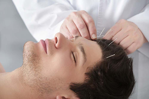 Acupuncture