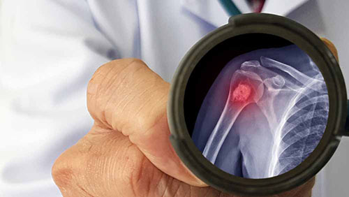 Oncologie Orthopédique