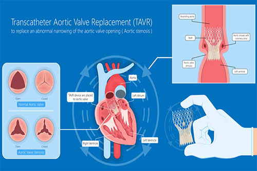 Chirurgies de la valve aortique