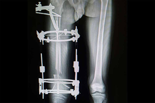 Leg Inequalities and Lengthening Treatment