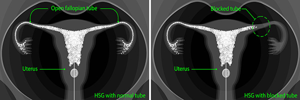 IVF (tup baby) and hysterosalpinography