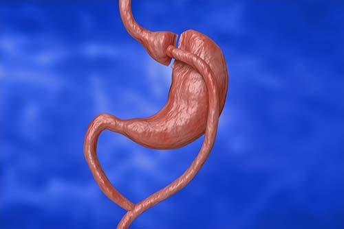 Quelle est la différence entre la gastrectomie en manchon et le bypass gastrique ?