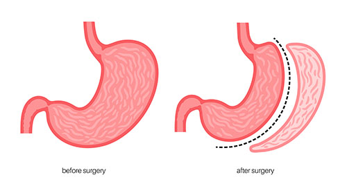 Quels sont les avantages de la chirurgie de l'estomac en fourreau (sleeve gastrectomie) ?