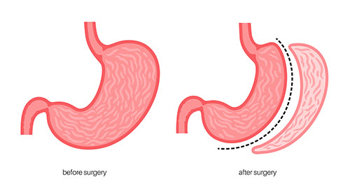 What are the Advantages of Tube Stomach Surgery (Sleeve Gastrectomy)?