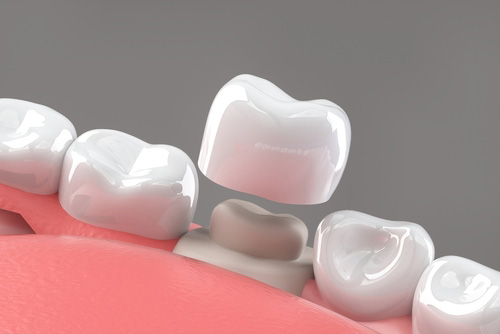 أنواع تيجان الأسنان المختلفة