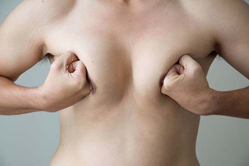 What Causes Gynecomastia?