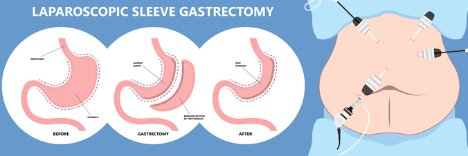 Comment la sleeve gastrectomie est-elle pratiquée ?