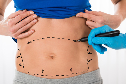 Liposuction Nasıl Yapılır?