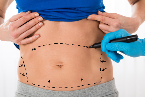 How is Liposuction Done?