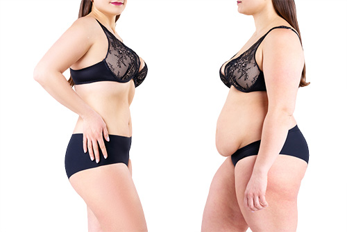 Liposuction ile Karın Germe