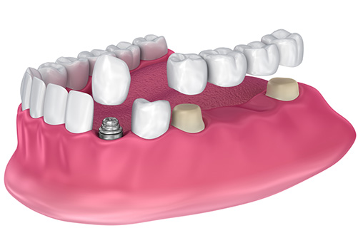 Durability and maintenance of dental crowns