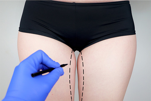 Thigh Lift Surgery in Turkey