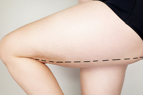 How is Thigh Lift Surgery Performed?