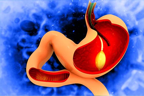 Quels sont les risques de la chirurgie de la gastrectomie en manchon ?