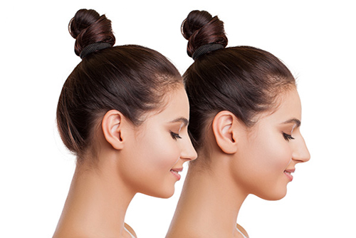 Rhinoplasty Nose Job Results