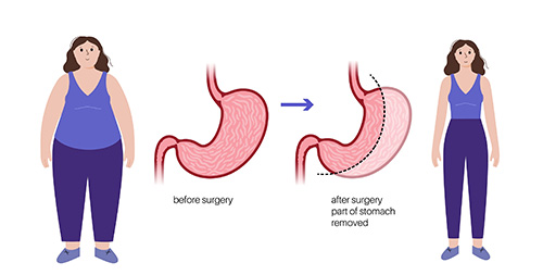 Signes et symptômes des complications après la chirurgie de la sleeve gastrique