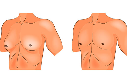 What is Gynecomastia?