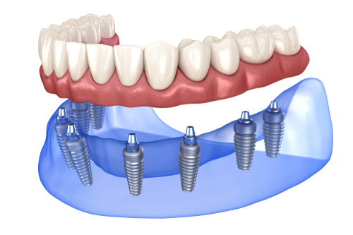 All-on-6 / All-on-8: كيف يعمل العلاج؟