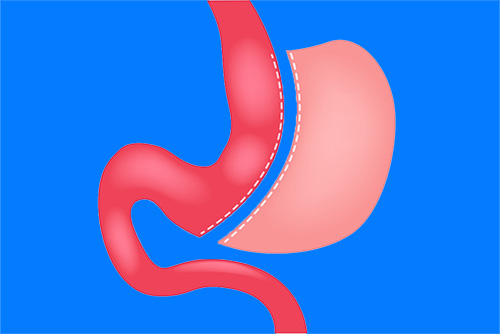 Does the Stomach Enlarge After Tube Stomach Surgery (Sleeve Gastrectomy)?