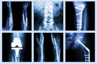 Ortopédie Et Traumatologie